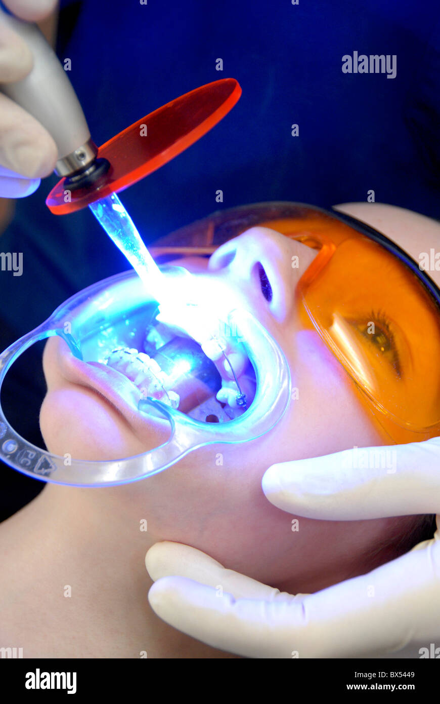 Children braces teeth hi-res stock photography and images - Alamy