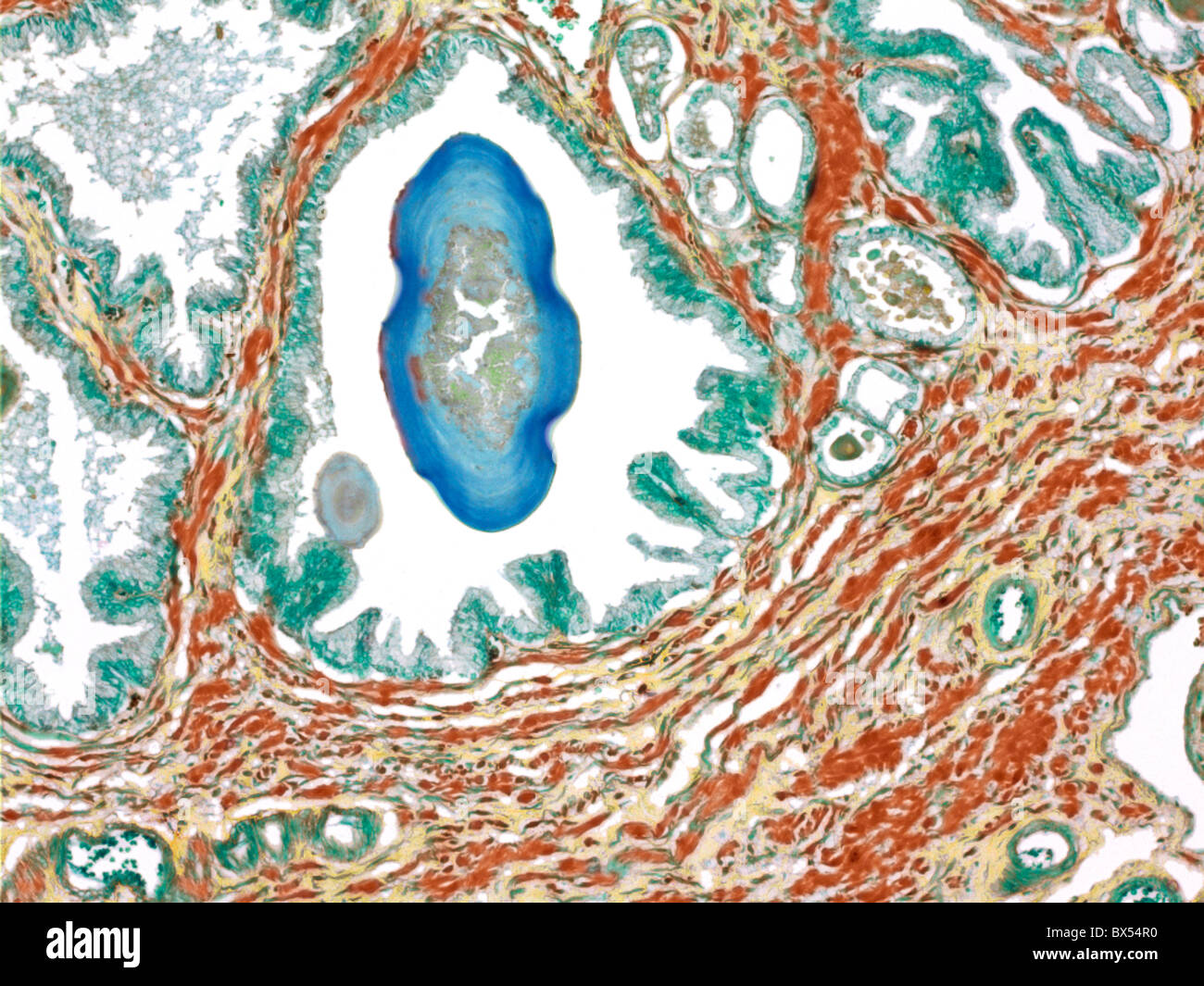Prostate, light micrograph Stock Photo