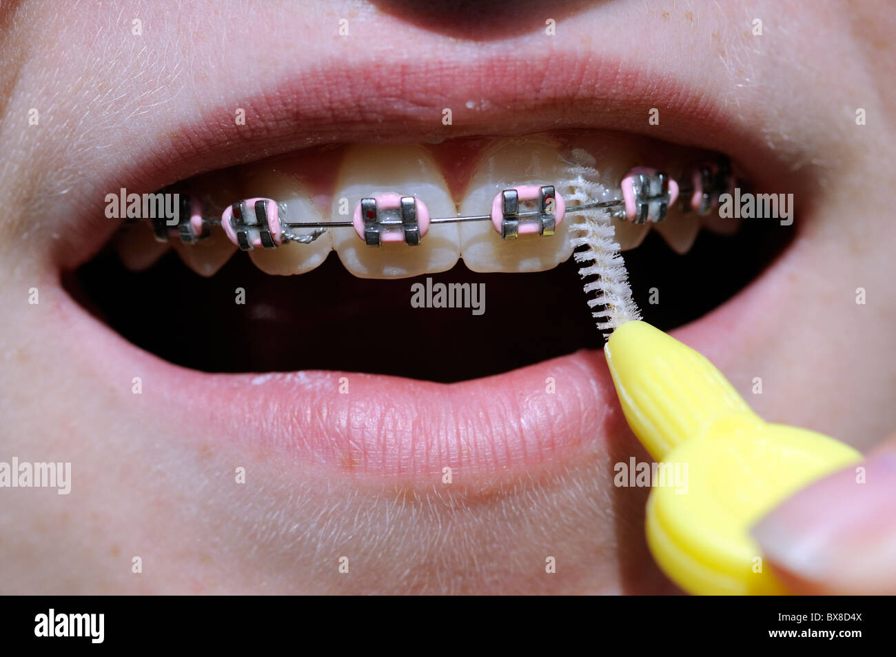Child's mouth with dental brush cleaning beneath the wire brace Stock