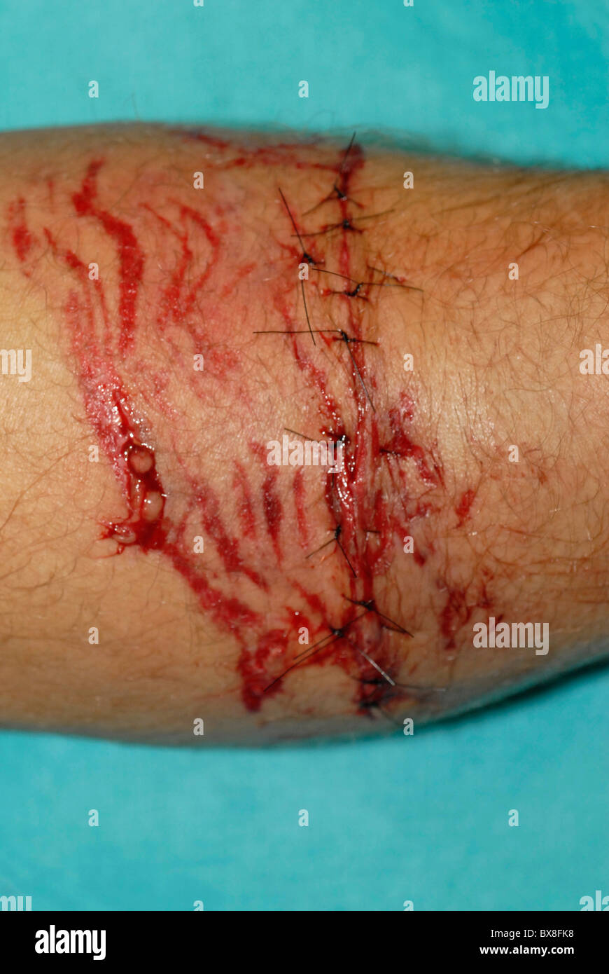 Sutured dogbite lacerations Stock Photo