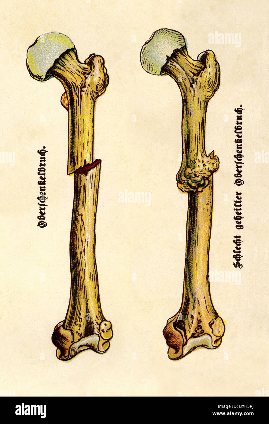 medicine, anatomy, fractures, fracture of the femur, Germany, circa 1900, Additional-Rights-Clearences-Not Available Stock Photo