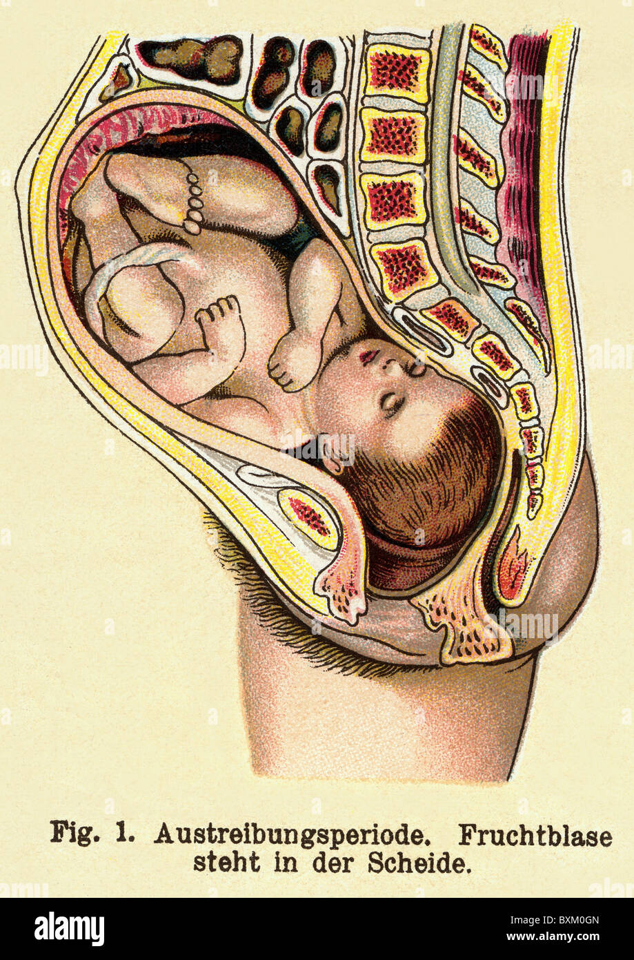 medicine, gynecology, birth, phase shortly before childbirth, lithograph, Germany, circa 1905, Additional-Rights-Clearences-Not Available Stock Photo