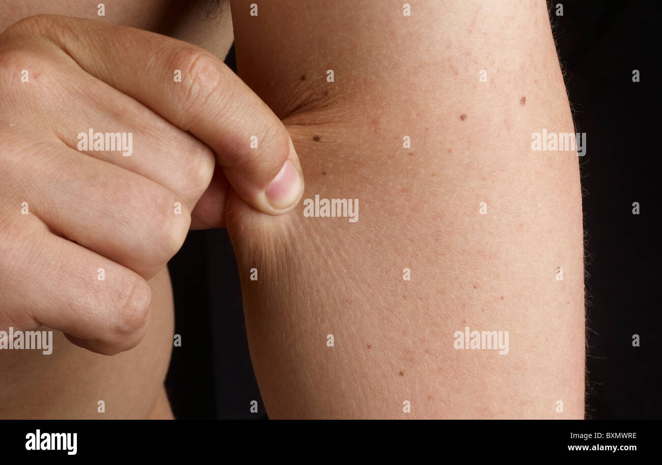 skin being pinched on an arm Stock Photo - Alamy