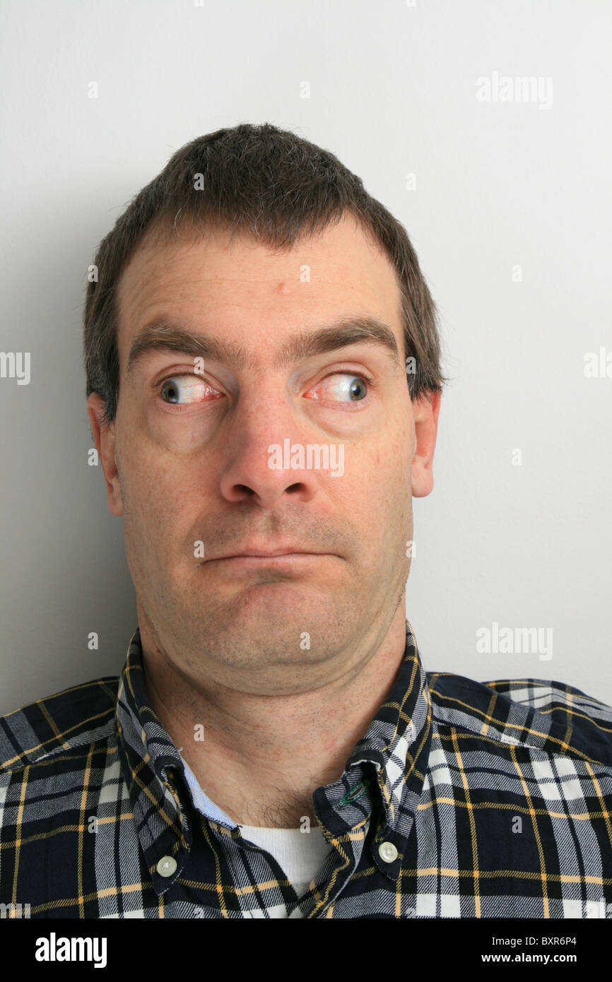 disturbing looking man with strabismus or walleye looking in different