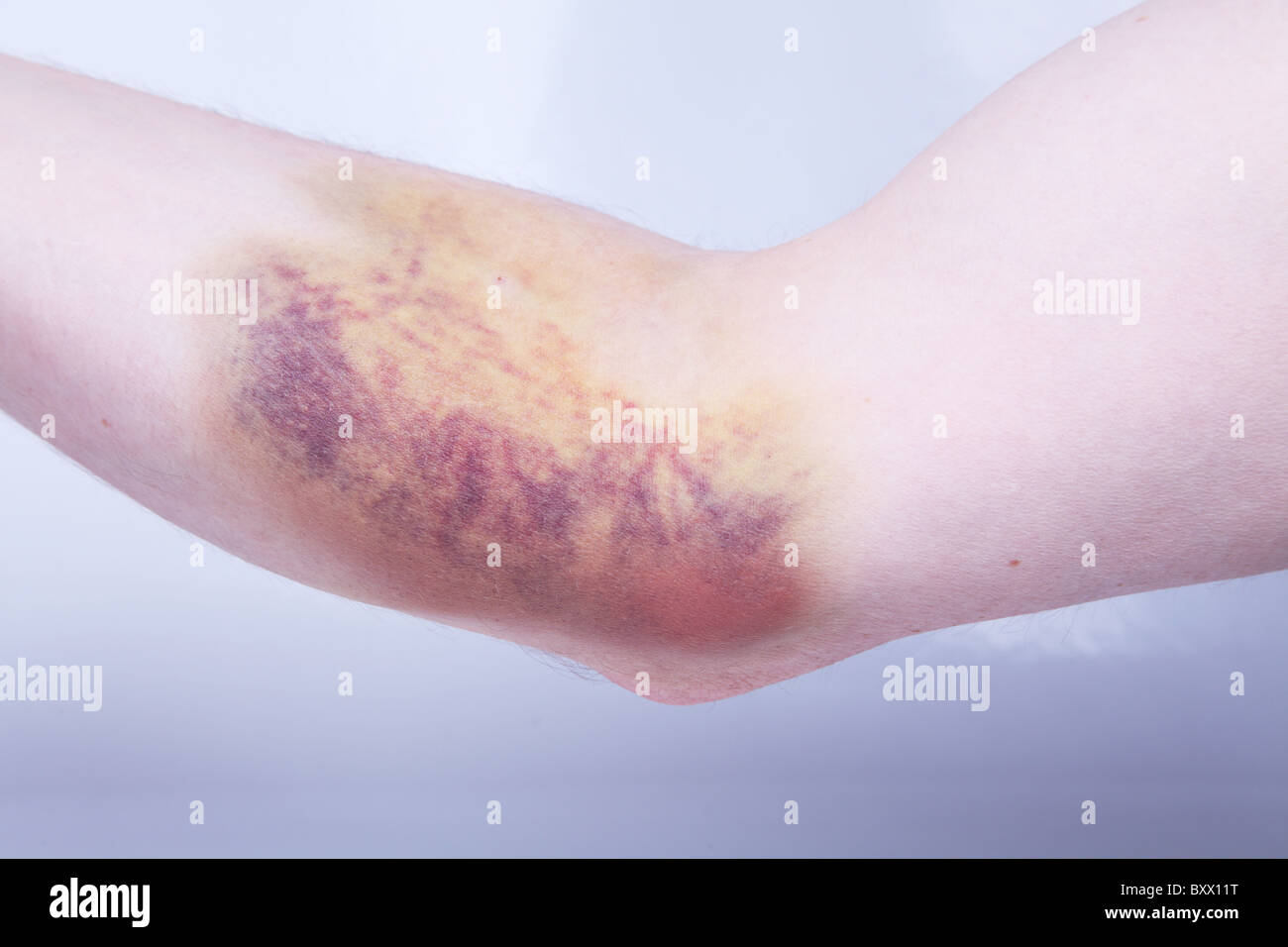 Bruising (hematoma, or haematoma) caused by internal bleeding as a result of blood sample having been taken. Stock Photo