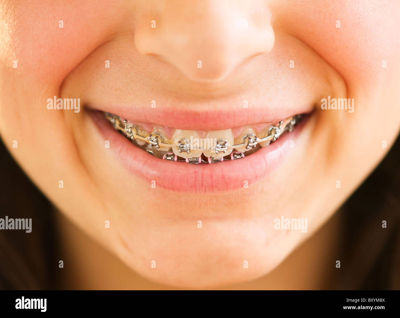 Close-up of girl's teeth braces Stock Photo