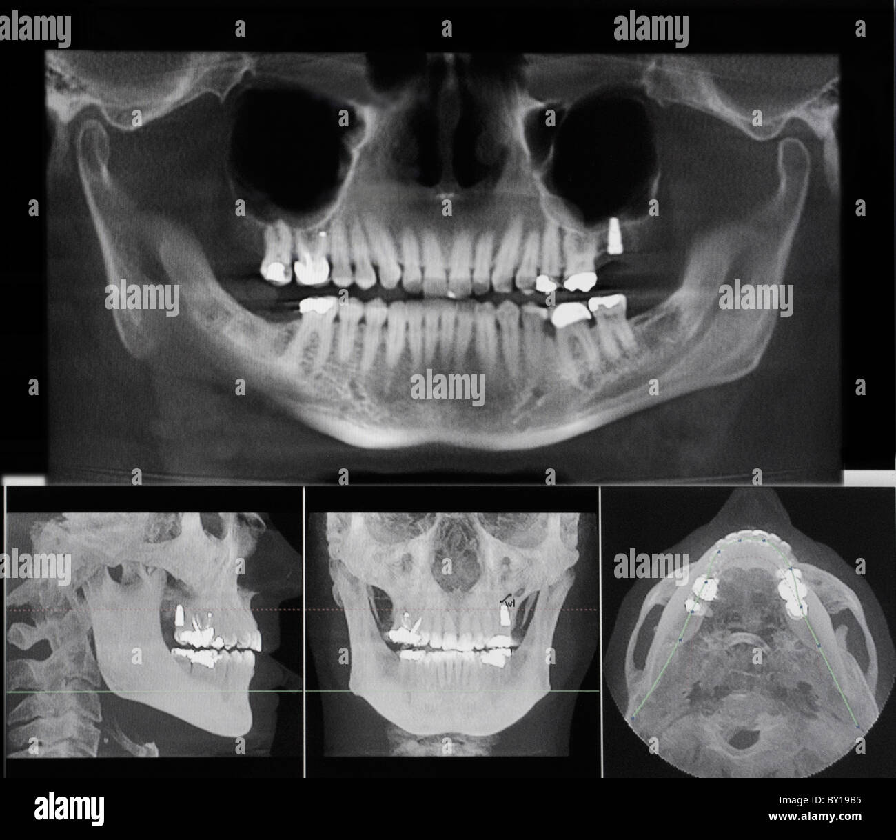 Teeth x-ray Stock Photo