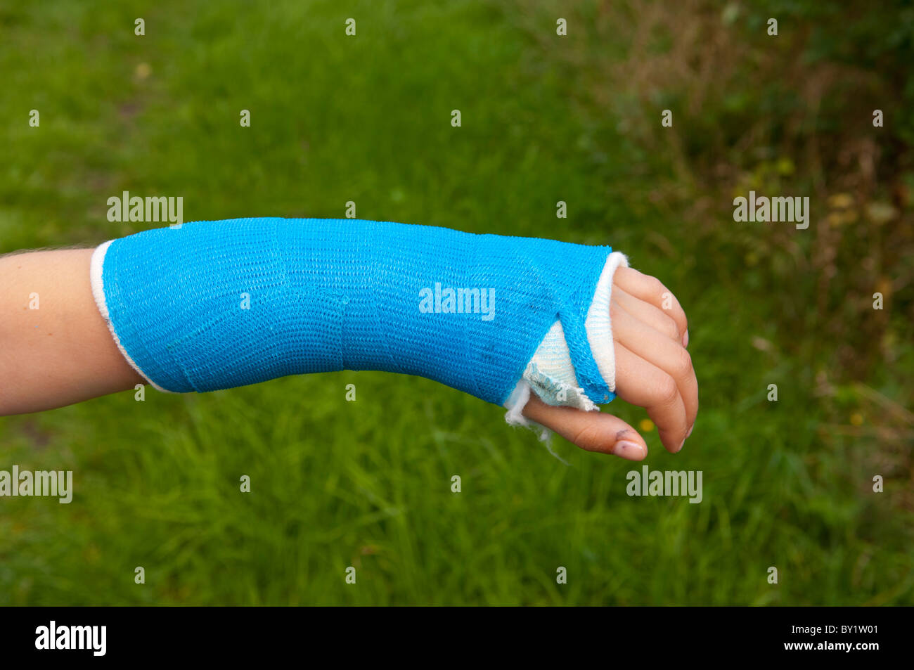 A MODEL RELEASED girl has her arm in a plaster having broken the bone
