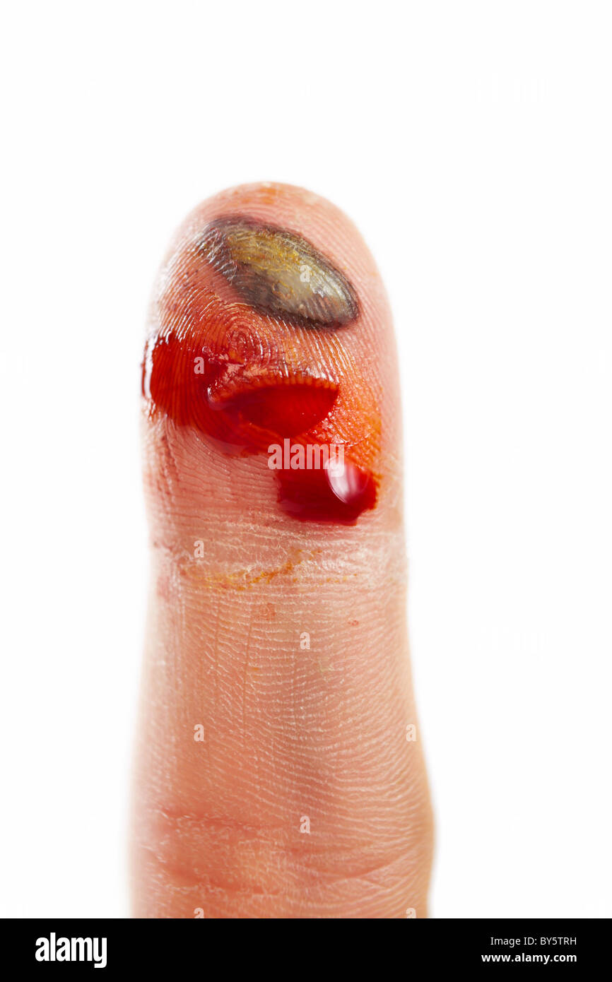 Bleeding wound finger, showing the flesh and the inflammation Stock Photo