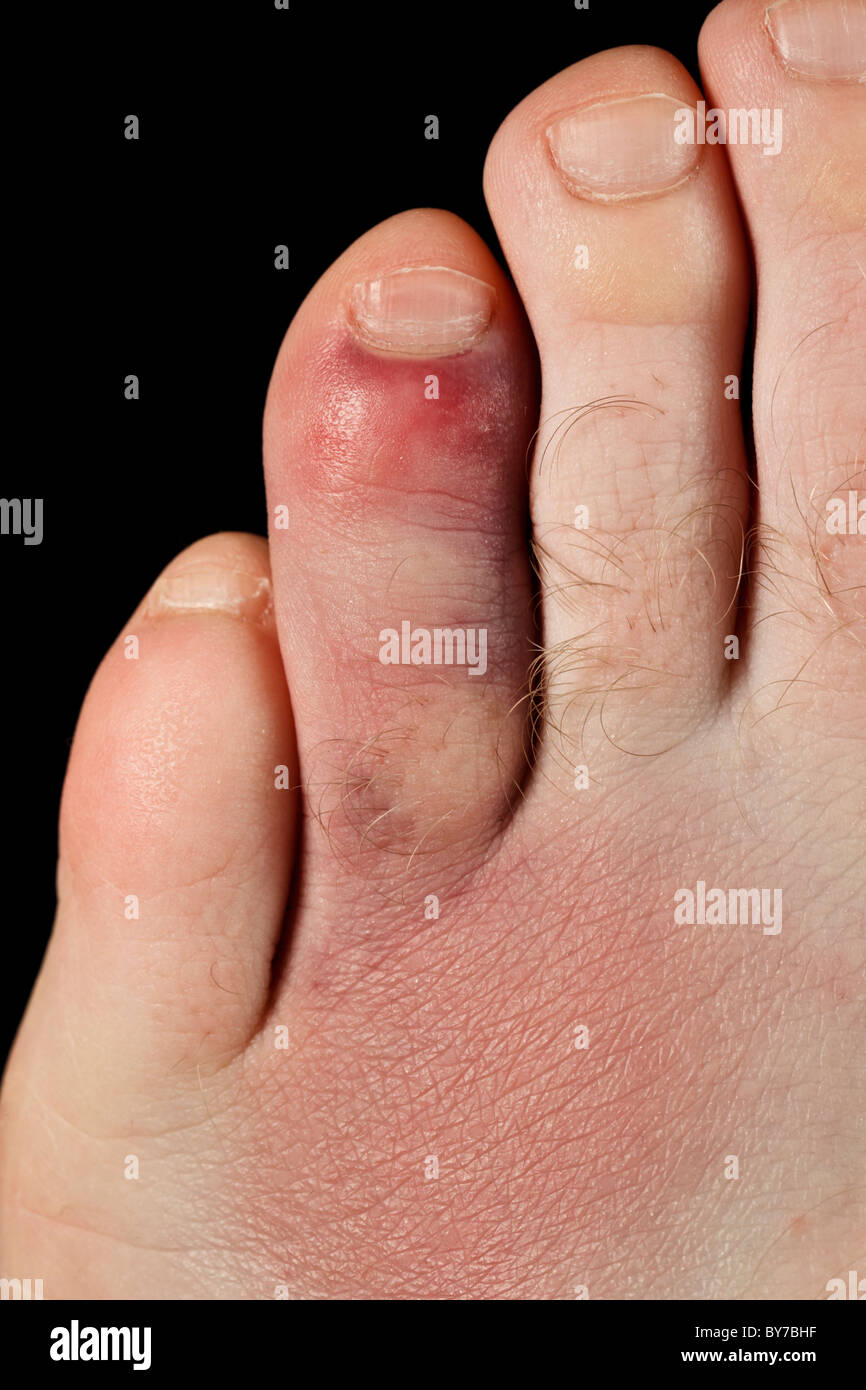 Broken toe hi-res stock photography and images - Alamy
