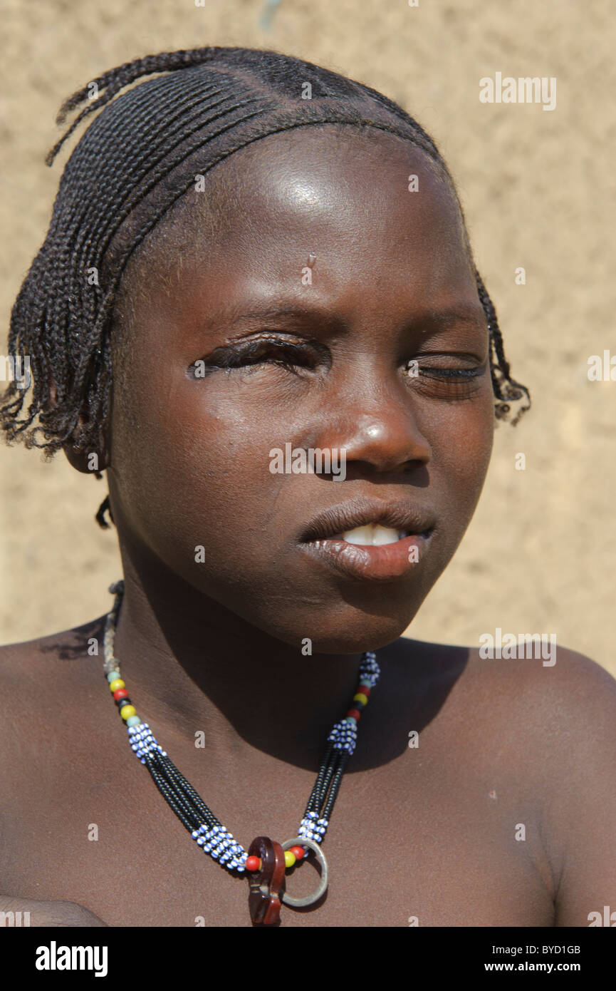 Young girl with eye disease. Mali. Stock Photo