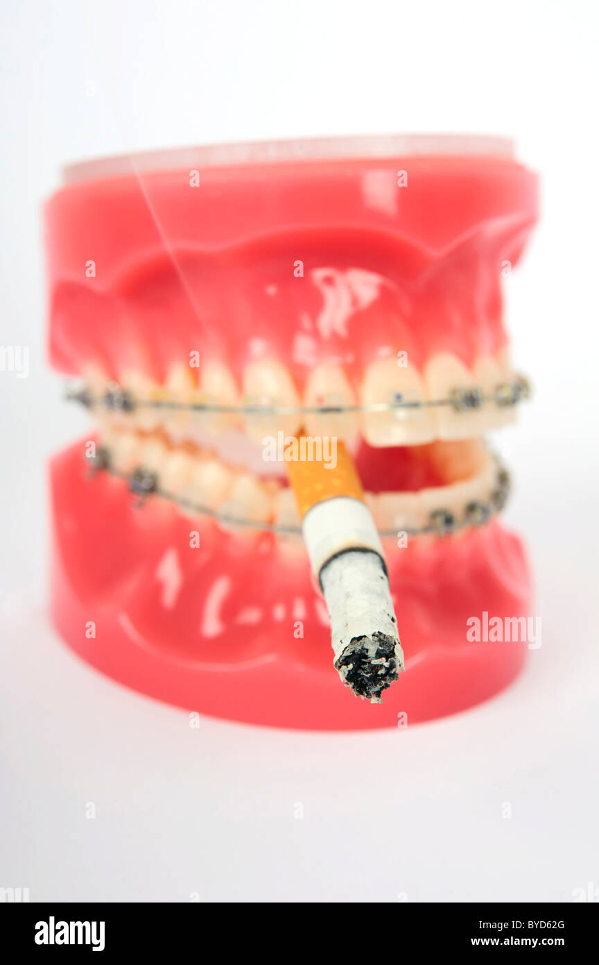 Symbolic image for adolescent smokers, dentures with fixed braces and a smoking cigarette Stock Photo