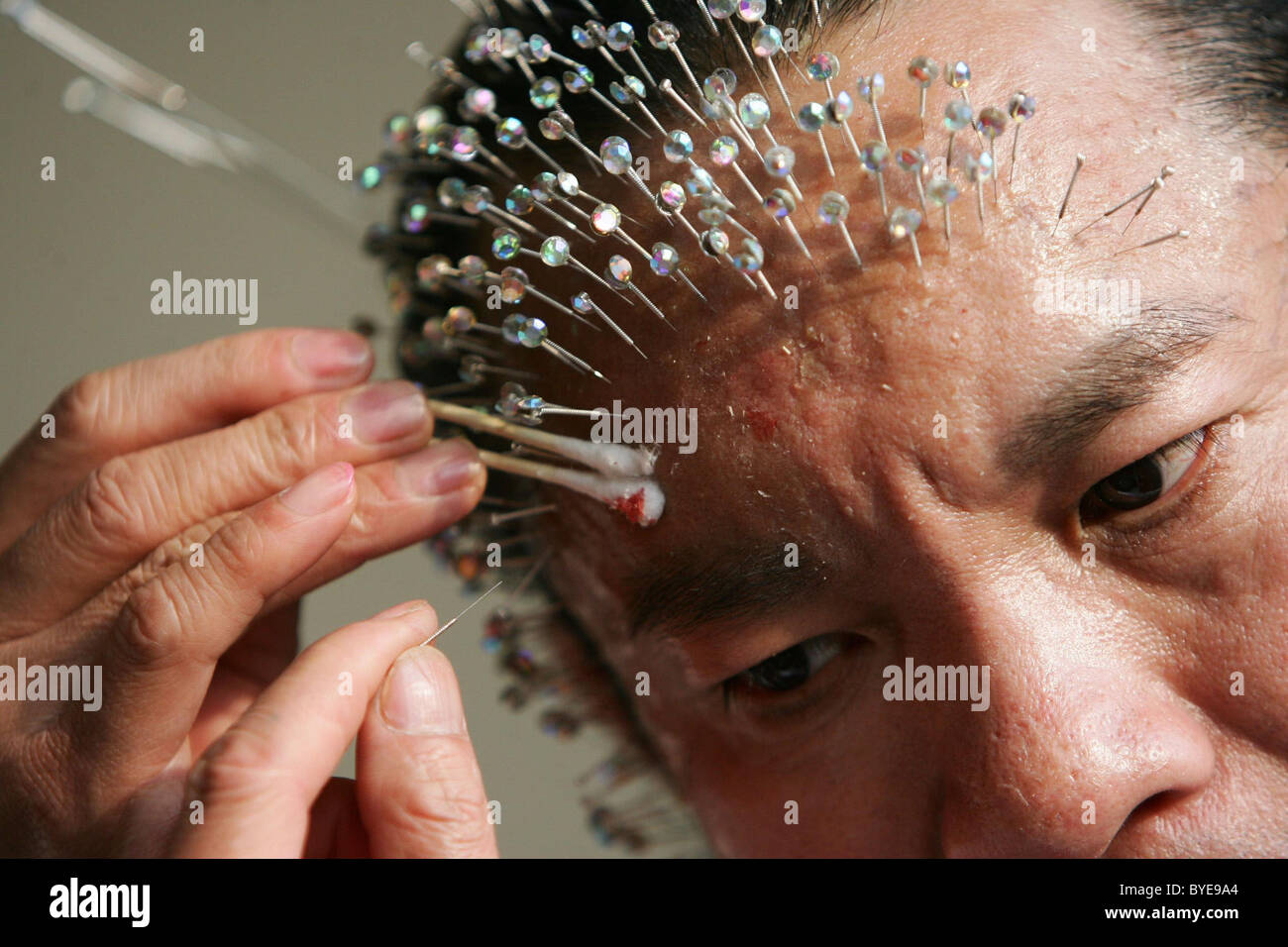 PRICK ADDICTION Wei Shengchu got hooked on needles after undergoing  acupuncture. After the needles were removed and his Stock Photo - Alamy