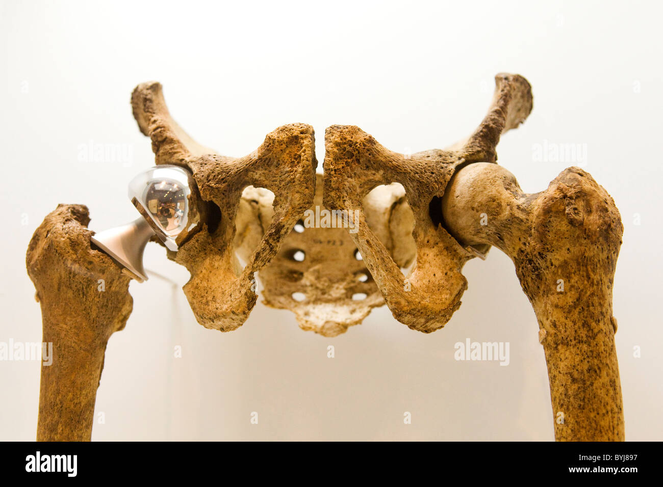 Pelvis showing a titanium prosthesis (Hip replacement Stock Photo Alamy