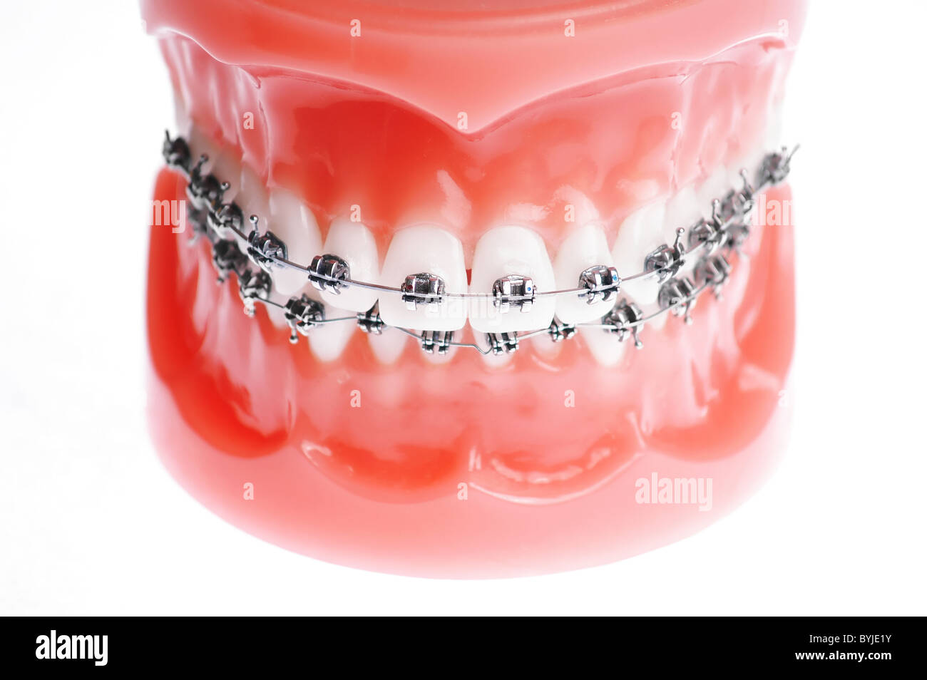 Dentures with braces isolated on white Stock Photo - Alamy