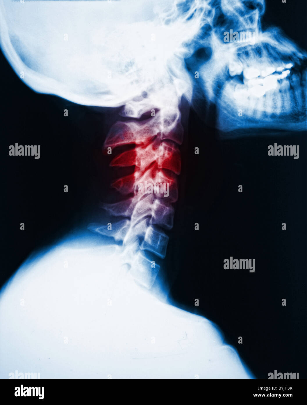 detail of neck x-ray image and red zone pain Stock Photo
