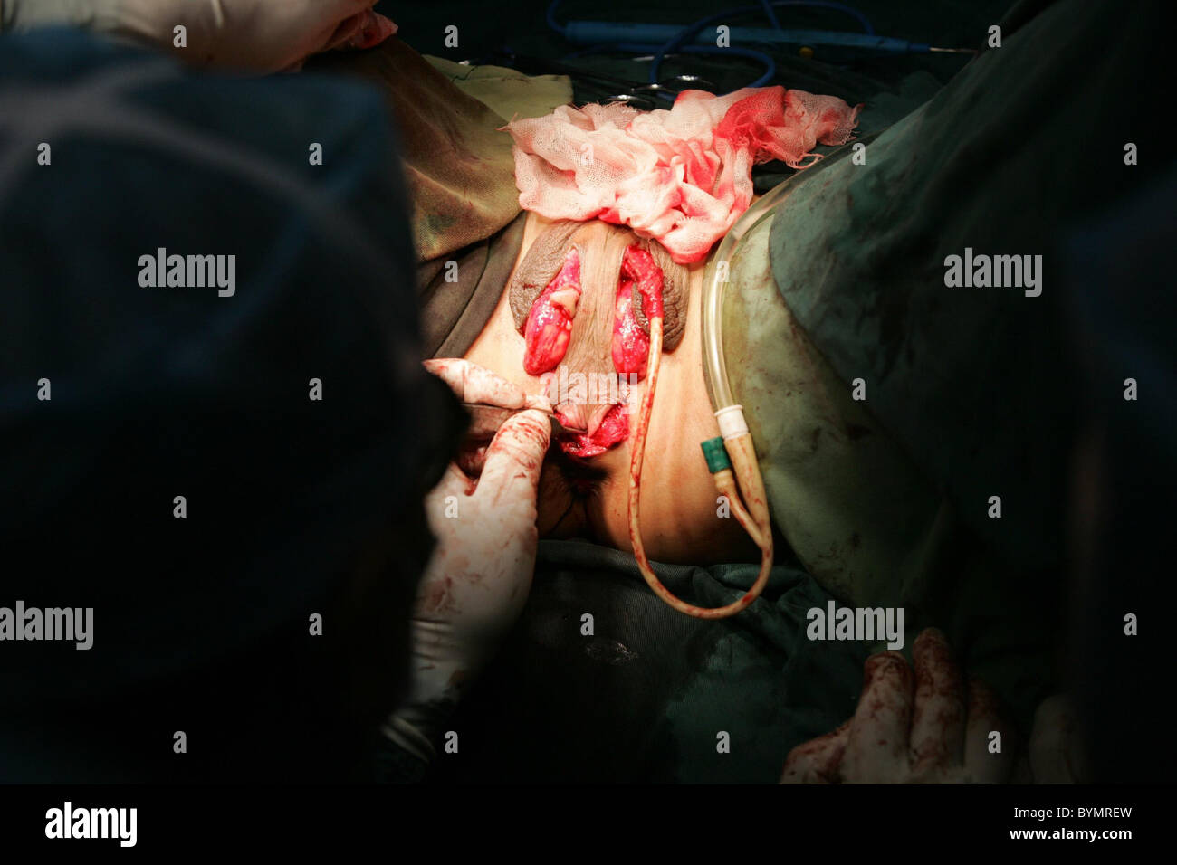 sex chang operation Sex chang operation
