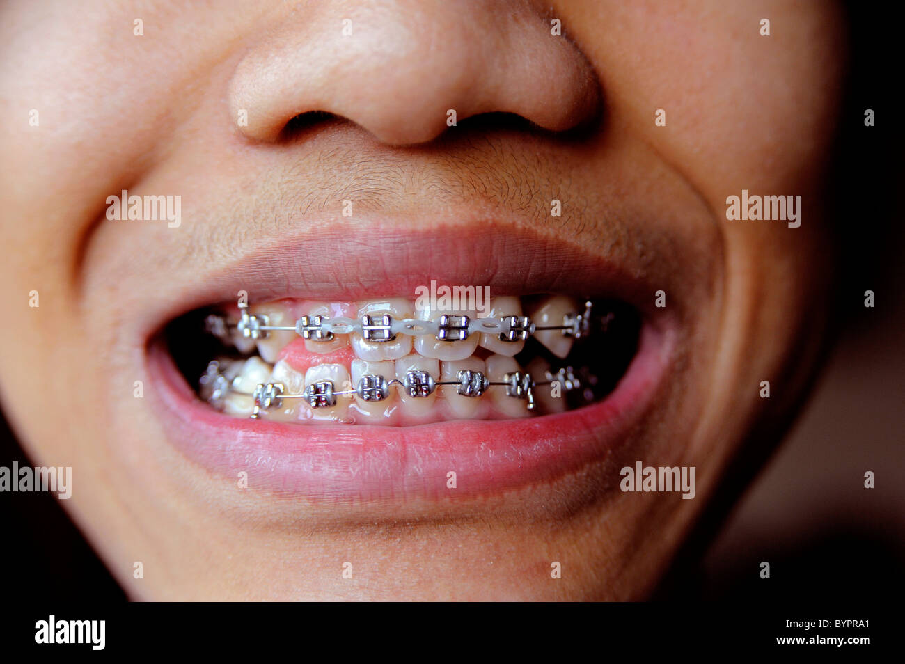 Boy With Orthodontics Braces High Resolution Stock Photography and
