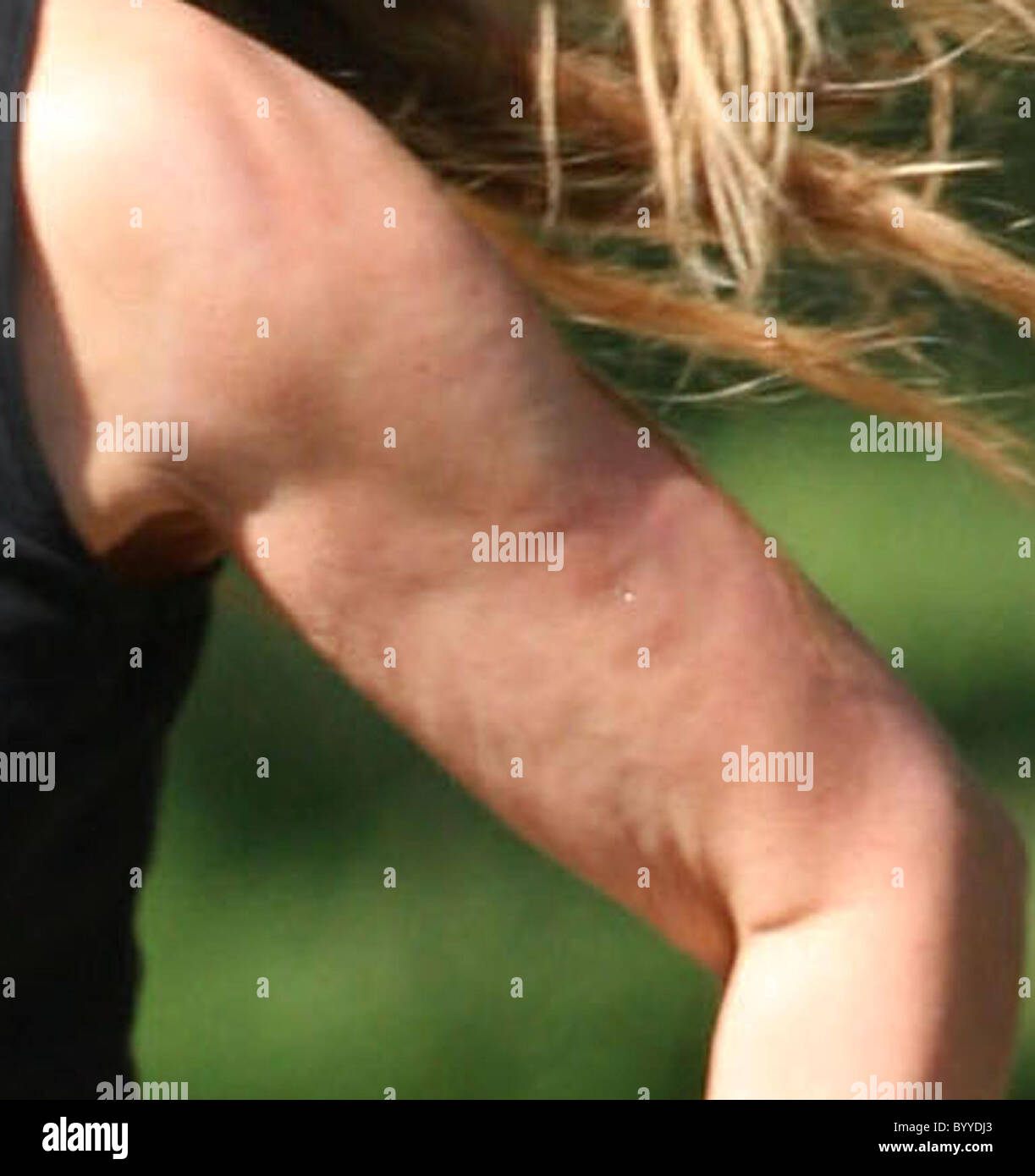 толстые целюлитные ноги. целлюлит на руках у женщин. целлюлит на руках. целлюлит на руках. липодистрофия целлюлит.