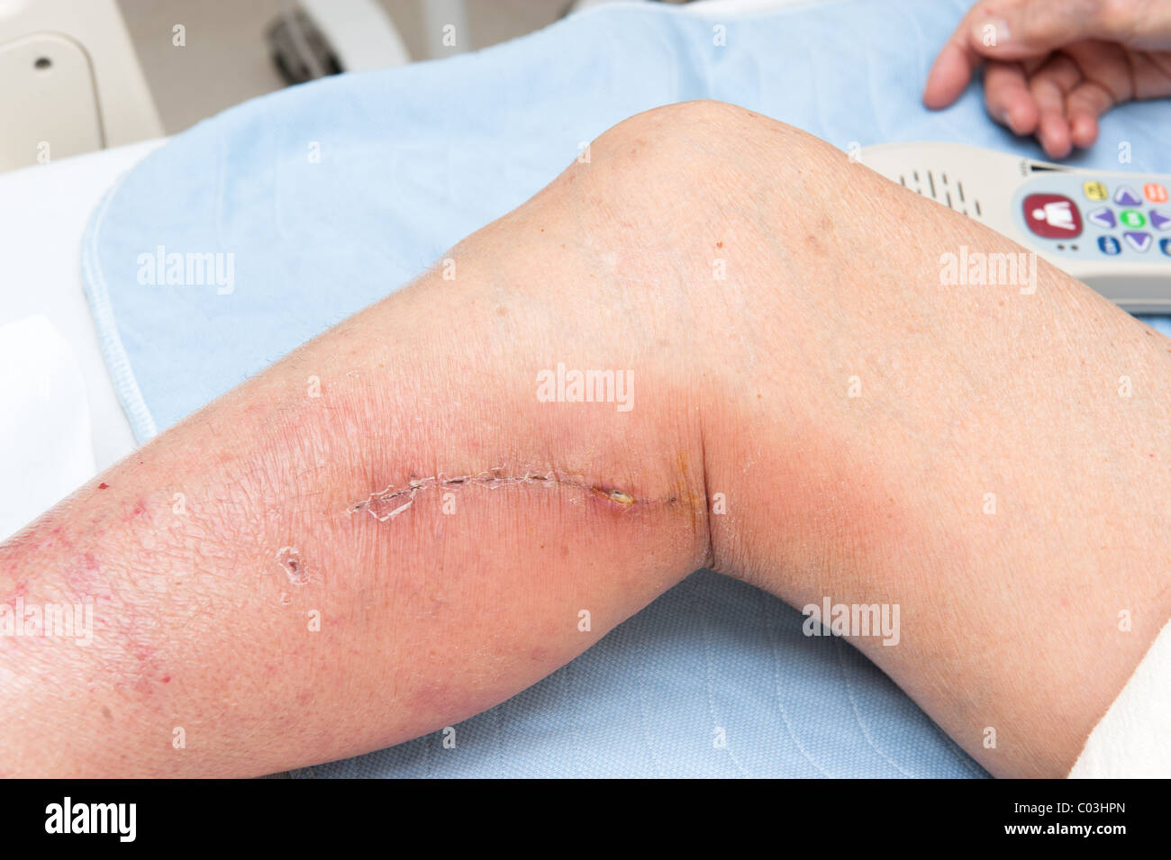 An elderly woman with an infected incision shows puss leaking out the end. Stock Photo
