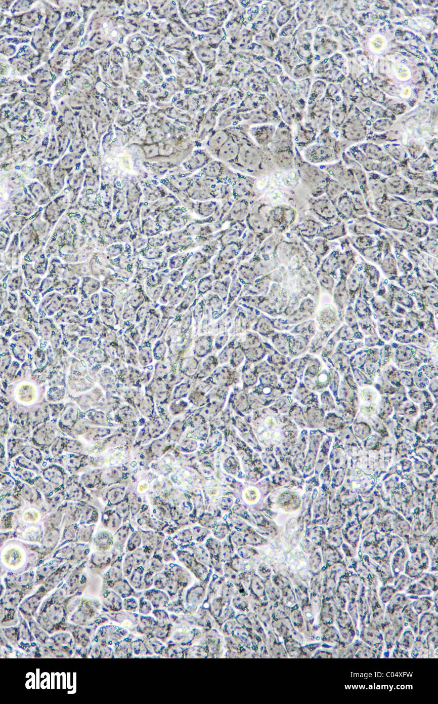 Microscope view of Colon Cancer cells in tissue culture showing walls and nucleus. Stock Photo
