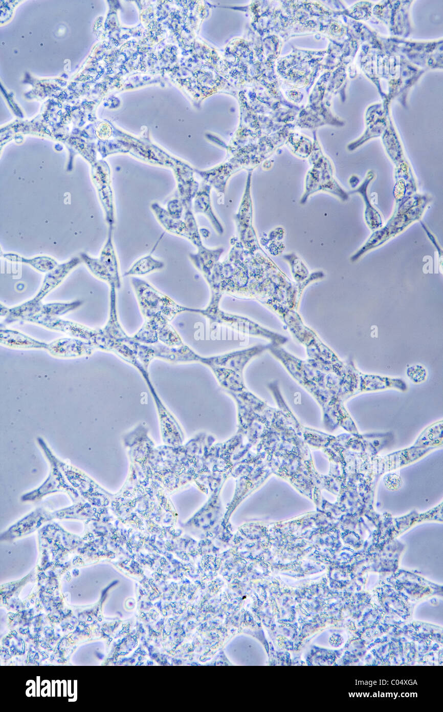 Microscope view of Prostate Cancer cells in tissue culture showing walls and nucleus. Stock Photo