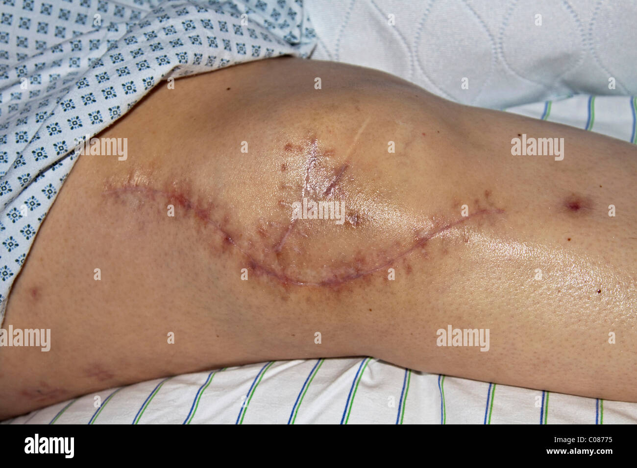 Fresh scar on an operated knee after insertion of implants after a serious traffic accident Stock Photo