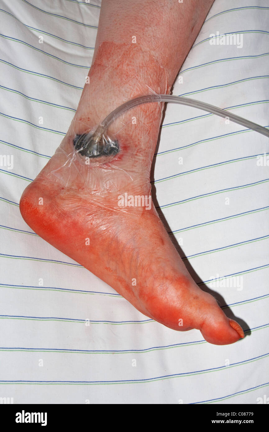 Drainage for wound discharge or pus on an ankle Stock Photo
