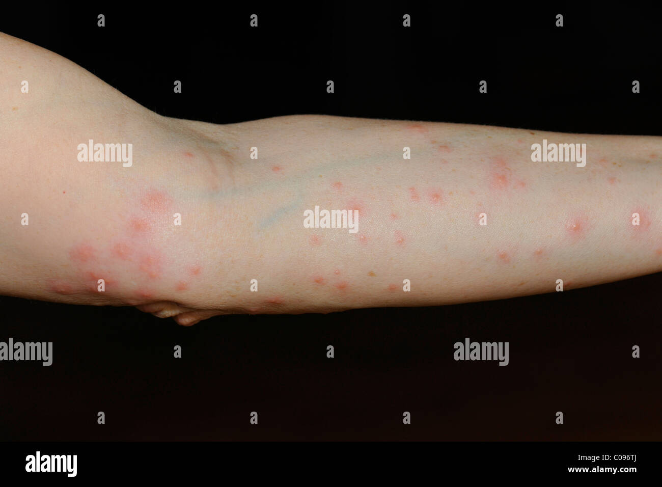 Wheals and nodules on an arm after an allergic reaction to harvest mites (Neotrombicula autumnalis) Stock Photo