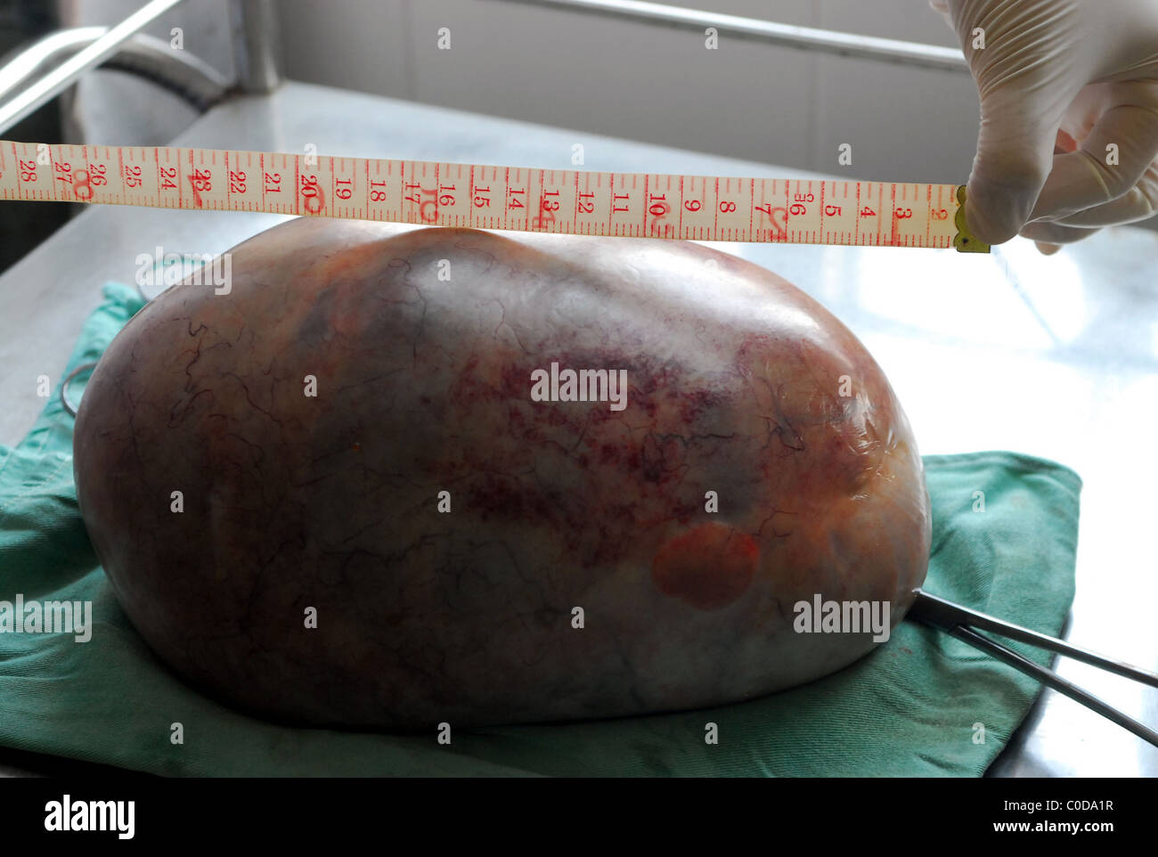 Ovarian Cyst Removed A Chinese Woman Thought She Was Expecting Her First Child Instead She Was Carrying A 3 5 Kilogram Stock Photo Alamy