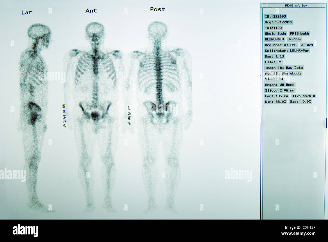 A Bone scan or bone scintigraphy is a nuclear scanning test to find certain abnormalities in bone Stock Photo