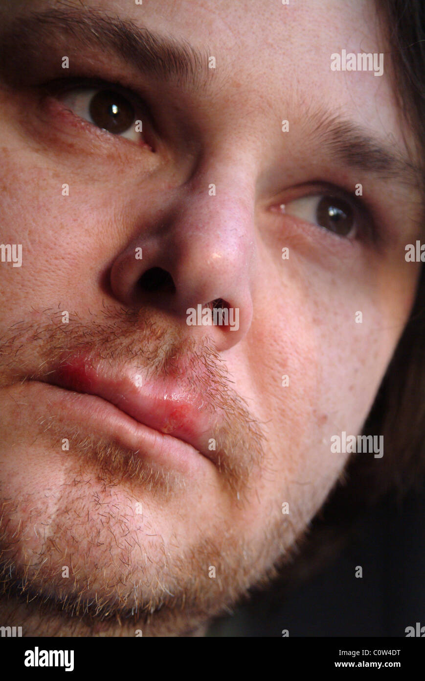 Head shot of a man with cold sores on his lips Stock Photo