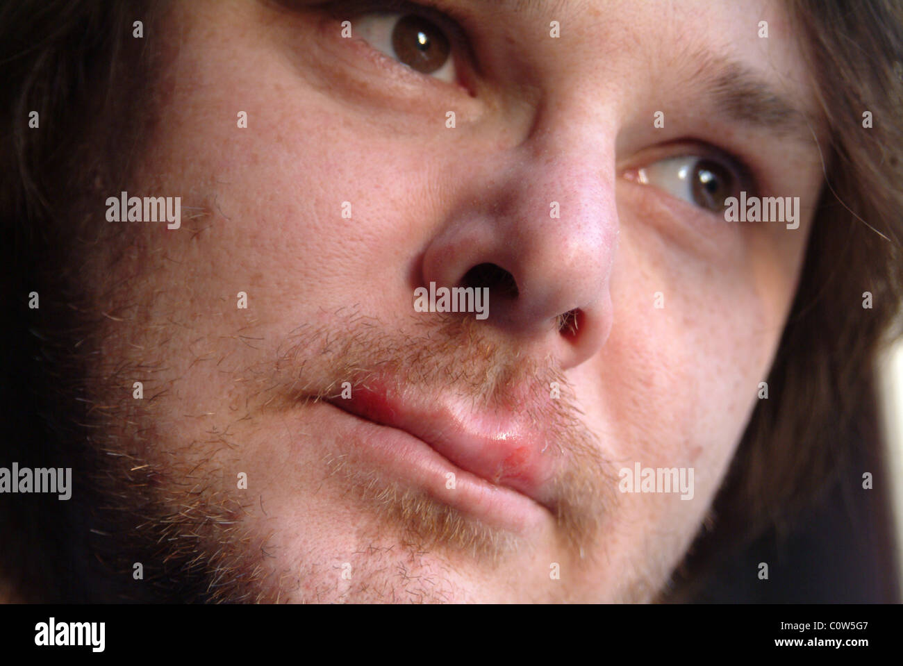 Head shot of a man with cold sores on his lips Stock Photo