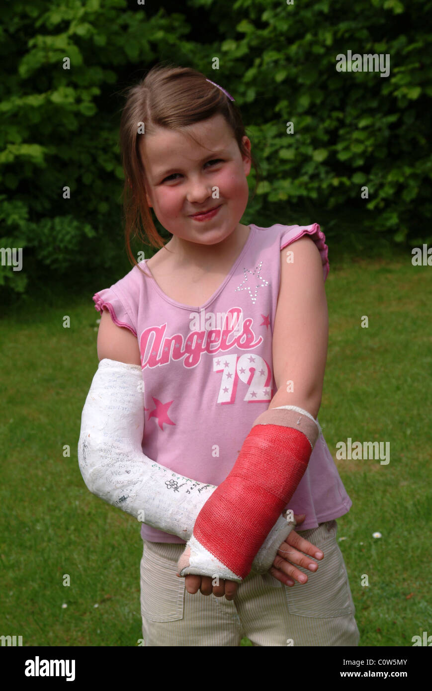 Both arms casts hires stock photography and images Alamy