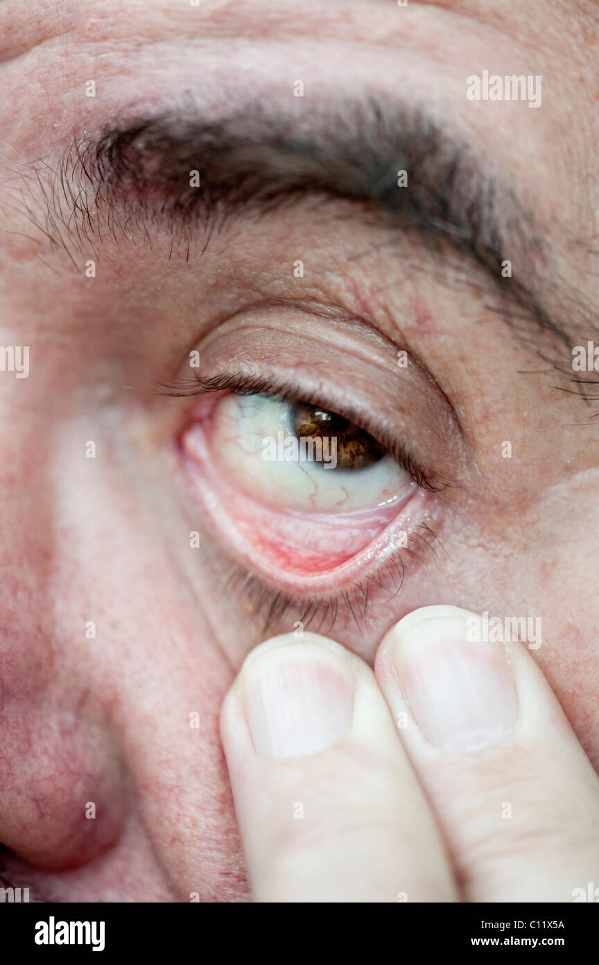 Fingers pulling an eyelid down Stock Photo