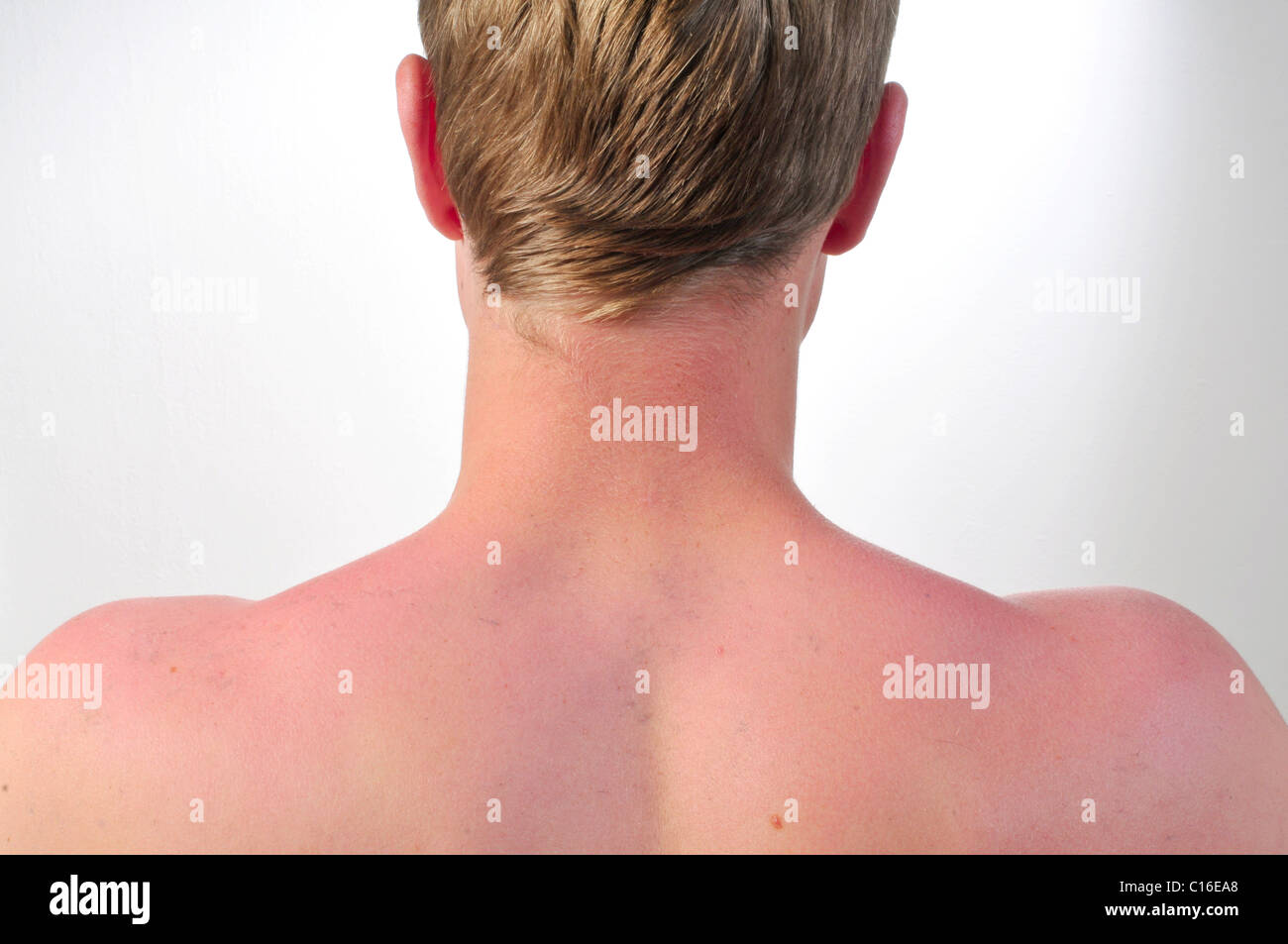 Sunburn Stock Photos & Sunburn Stock Images Alamy