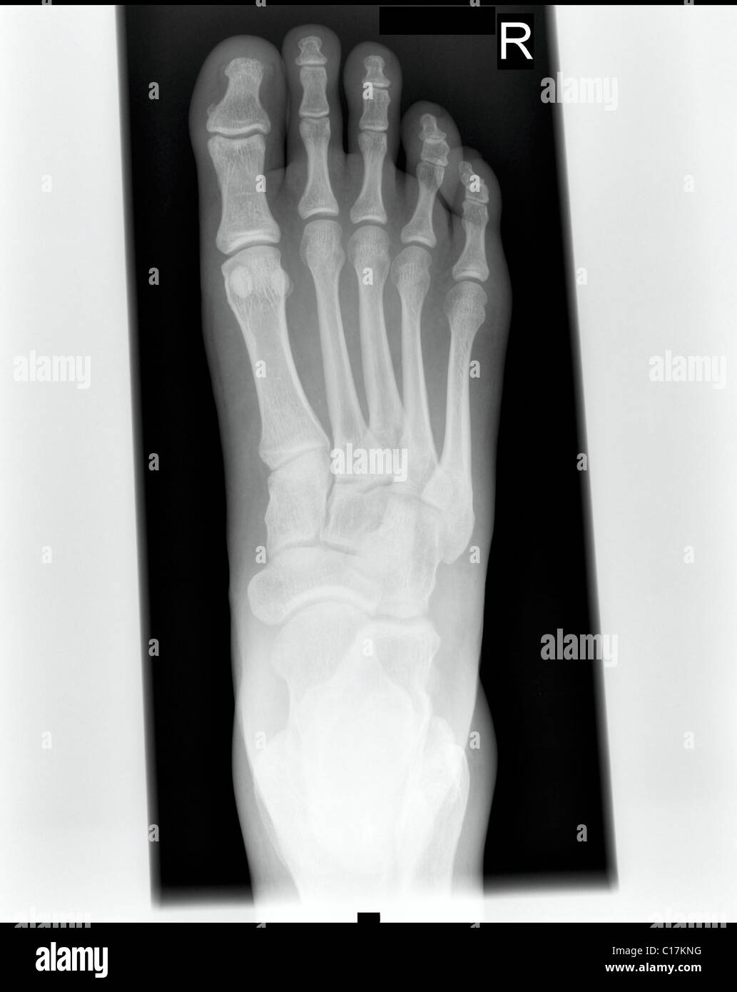 X-Ray medical imagery of a right male foot Stock Photo