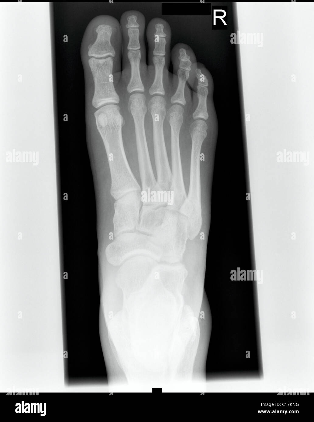 XRay picture of a right male foot Stock Photo 35204556 Alamy