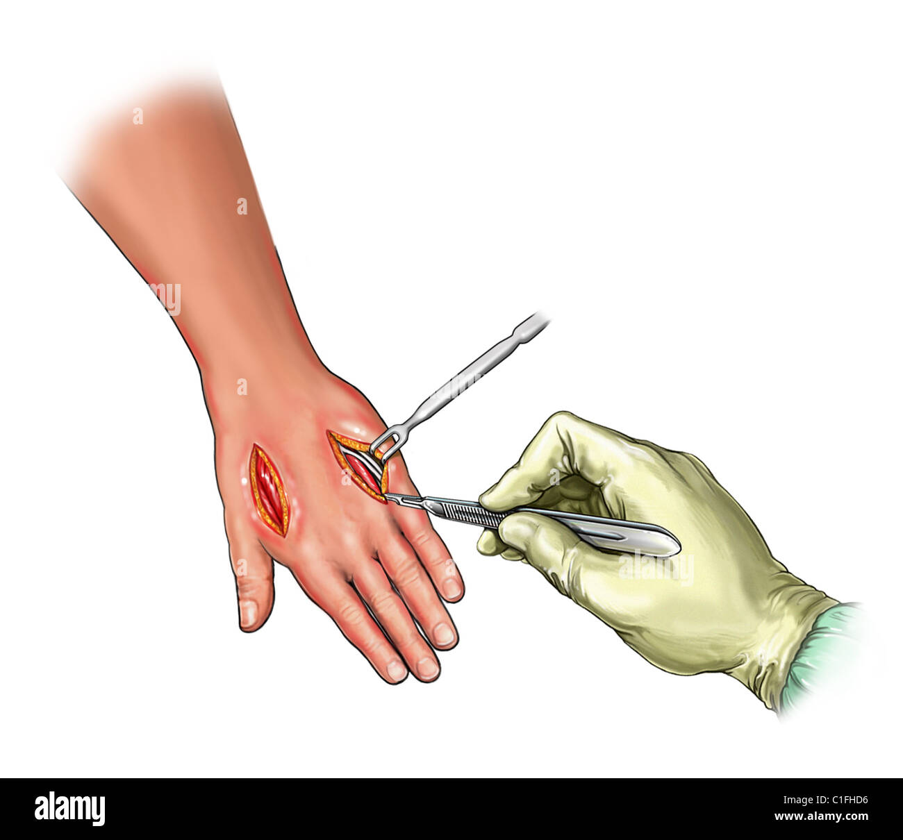 This medical illustration illustrates a fasciotomy to the dorsal Stock