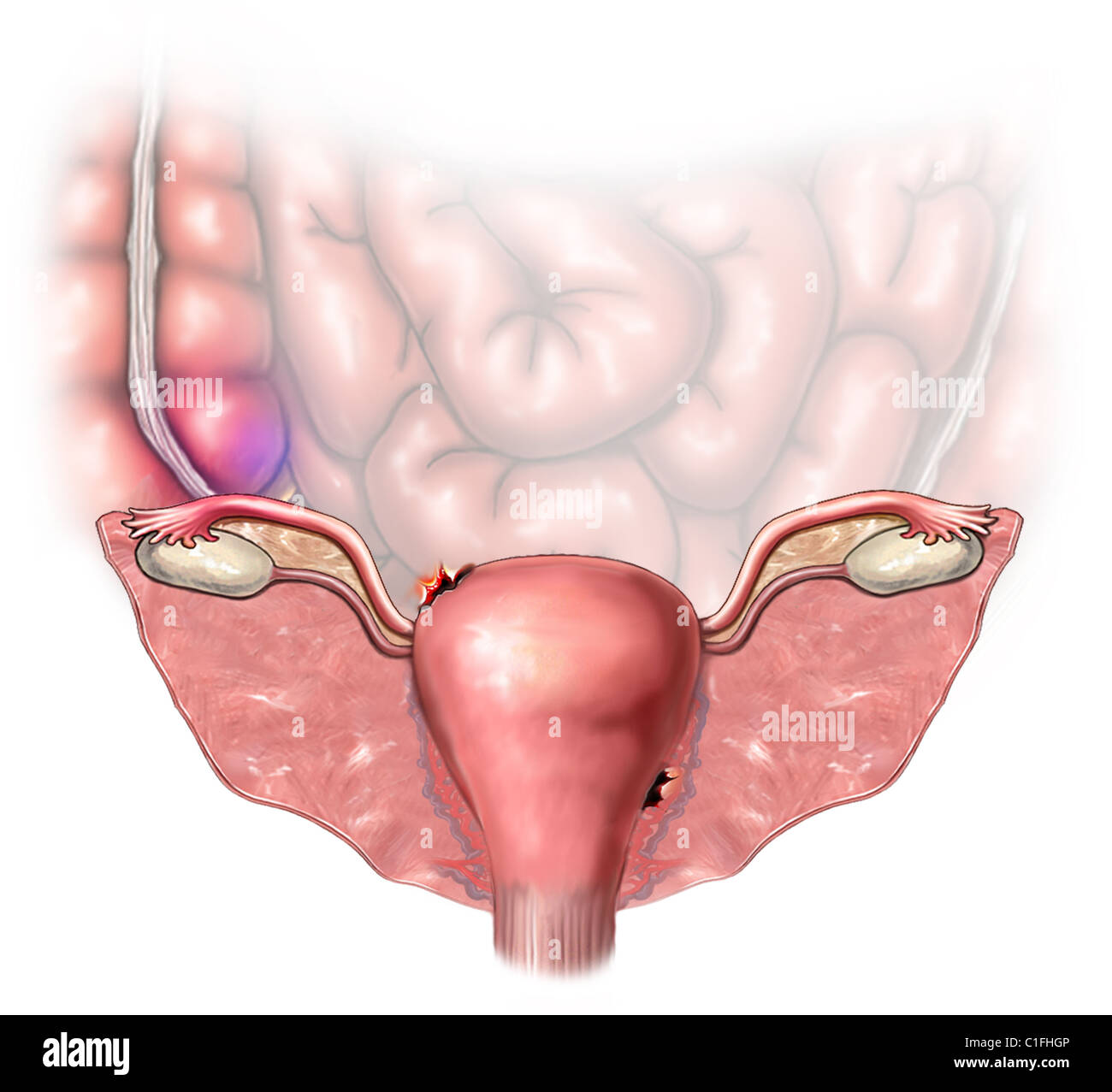 This medical illustration reveals a perforated uterus. Stock Photo