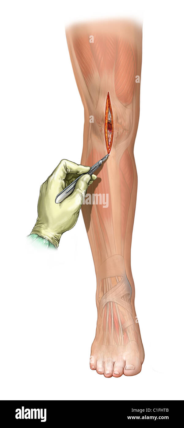 Midline Incision High Resolution Stock Photography and Images - Alamy