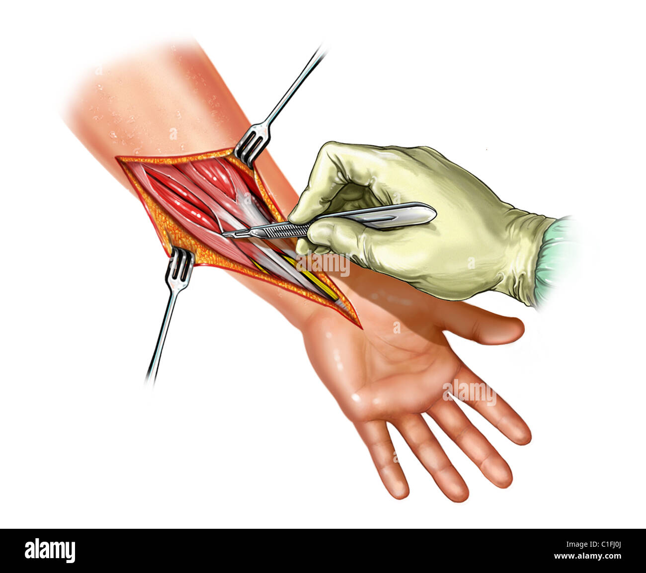 This medical illustration depicts a fasciotomy to the forearm. Stock Photo