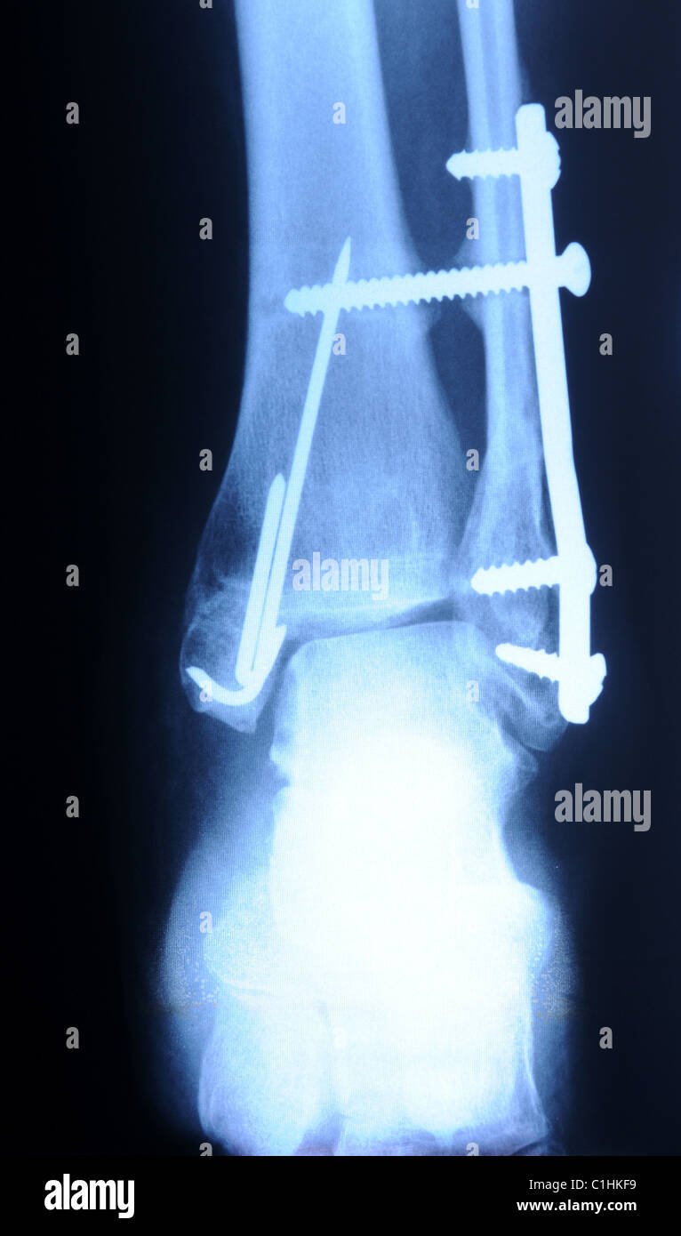 authentic x-ray picture of human fracture ankle with metal plate and screws Stock Photo