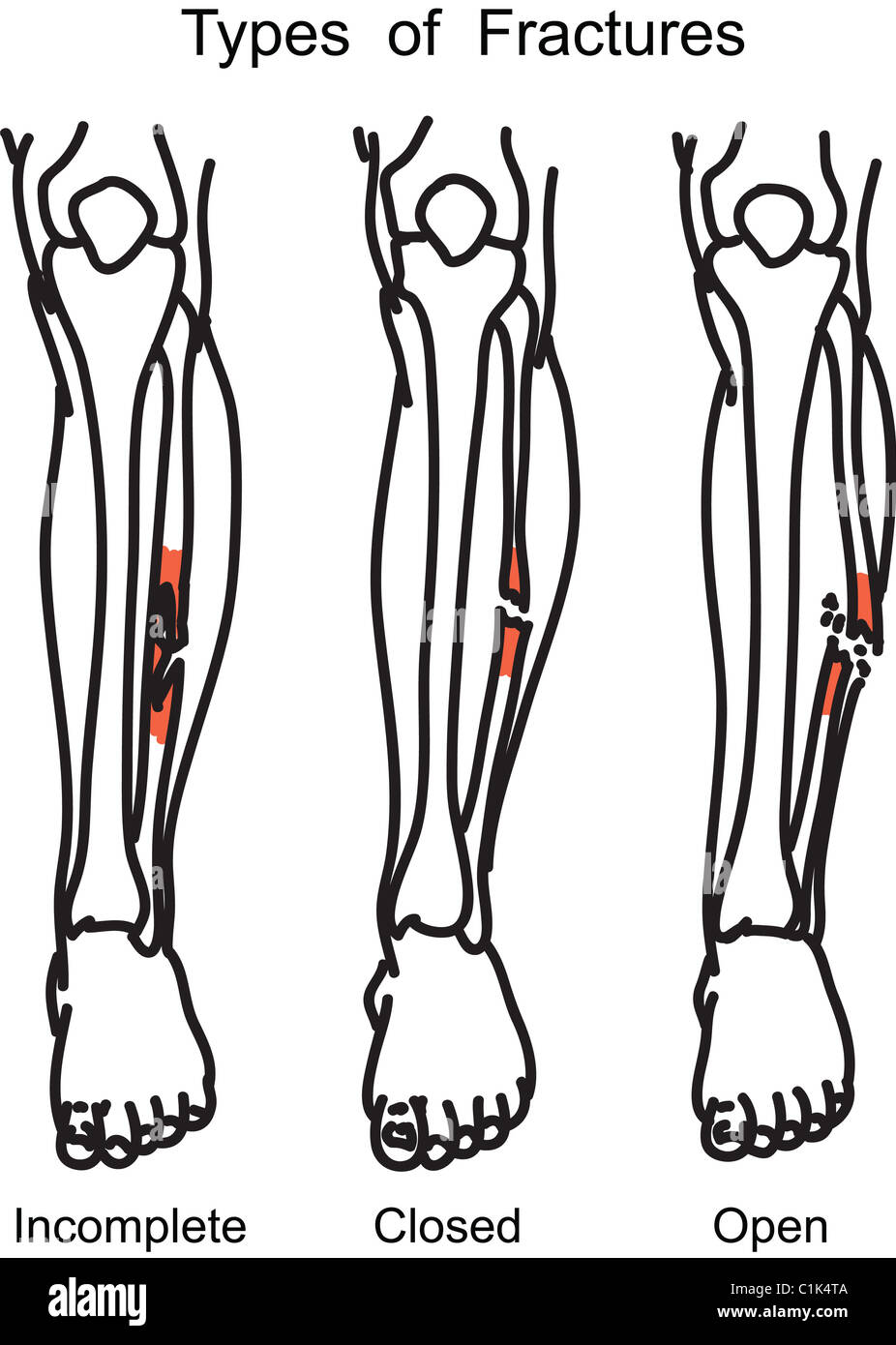 Types of human bone fractures illustration Stock Photo