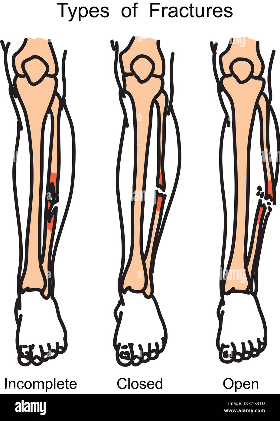 Types of human bone fractures illustration Stock Photo