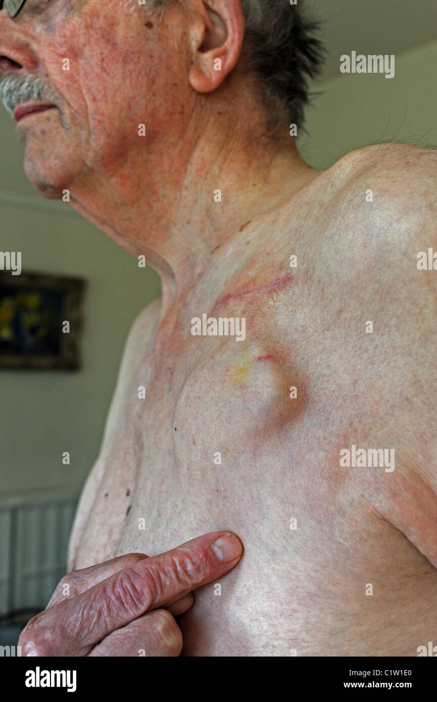 Elderly male with an implantable cardioverter-defibrillator (ICD) or pacemaker device fitted near collarbone to help the heart Stock Photo