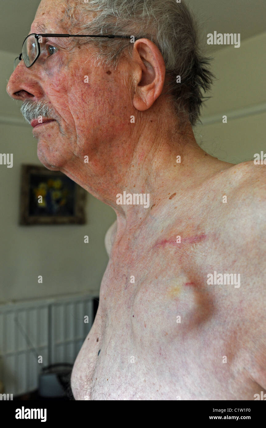 Elderly male with an implantable cardioverter-defibrillator (ICD) or pacemaker device fitted near collarbone to help the heart Stock Photo