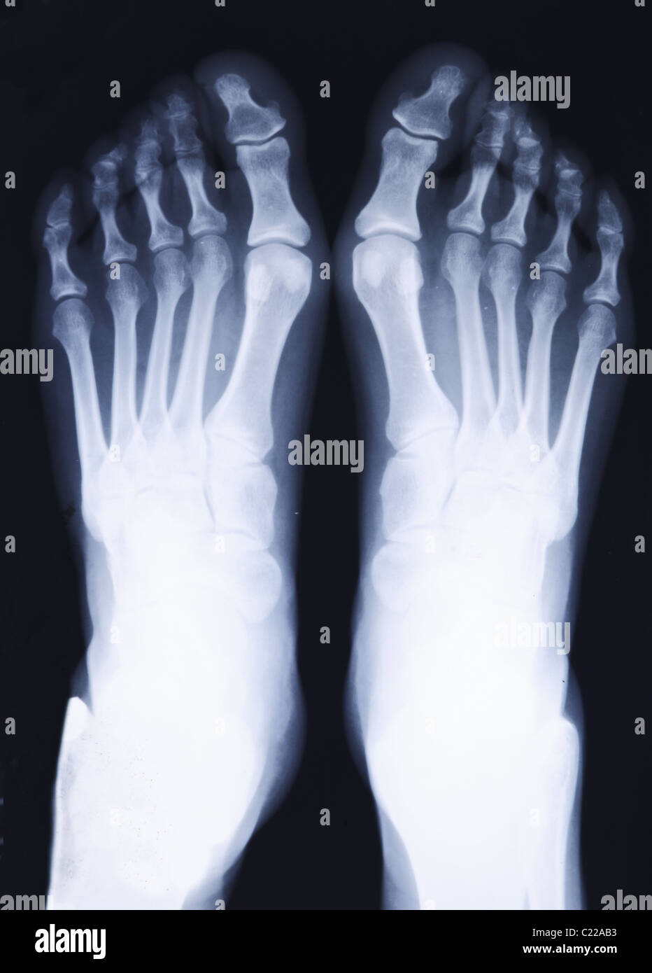 closeup image of classic xray image of feet Stock Photo