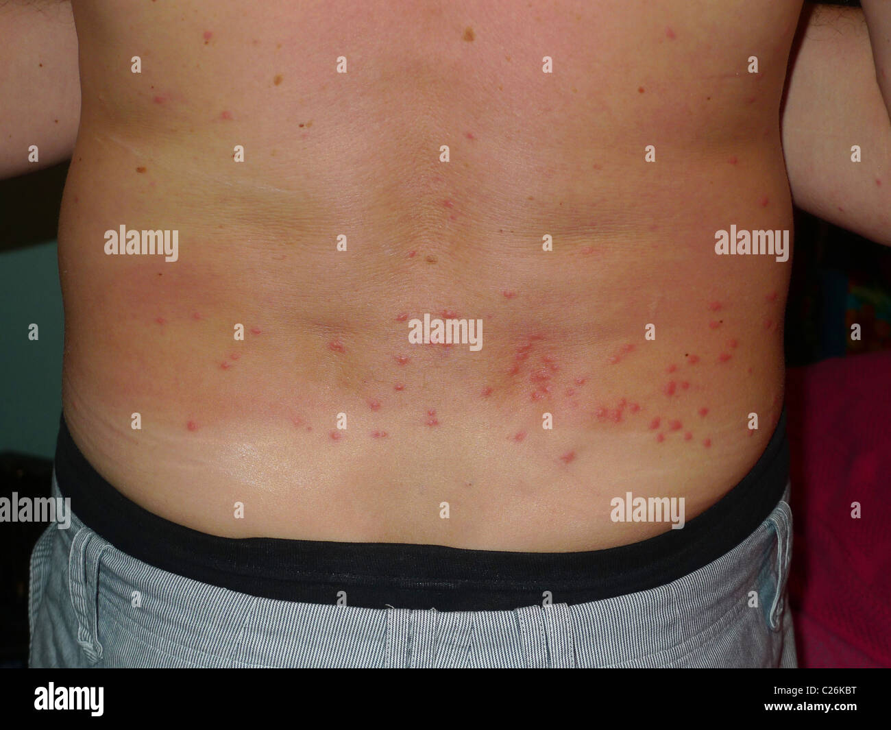 Sand Fleas Rash sand-fleas-rash