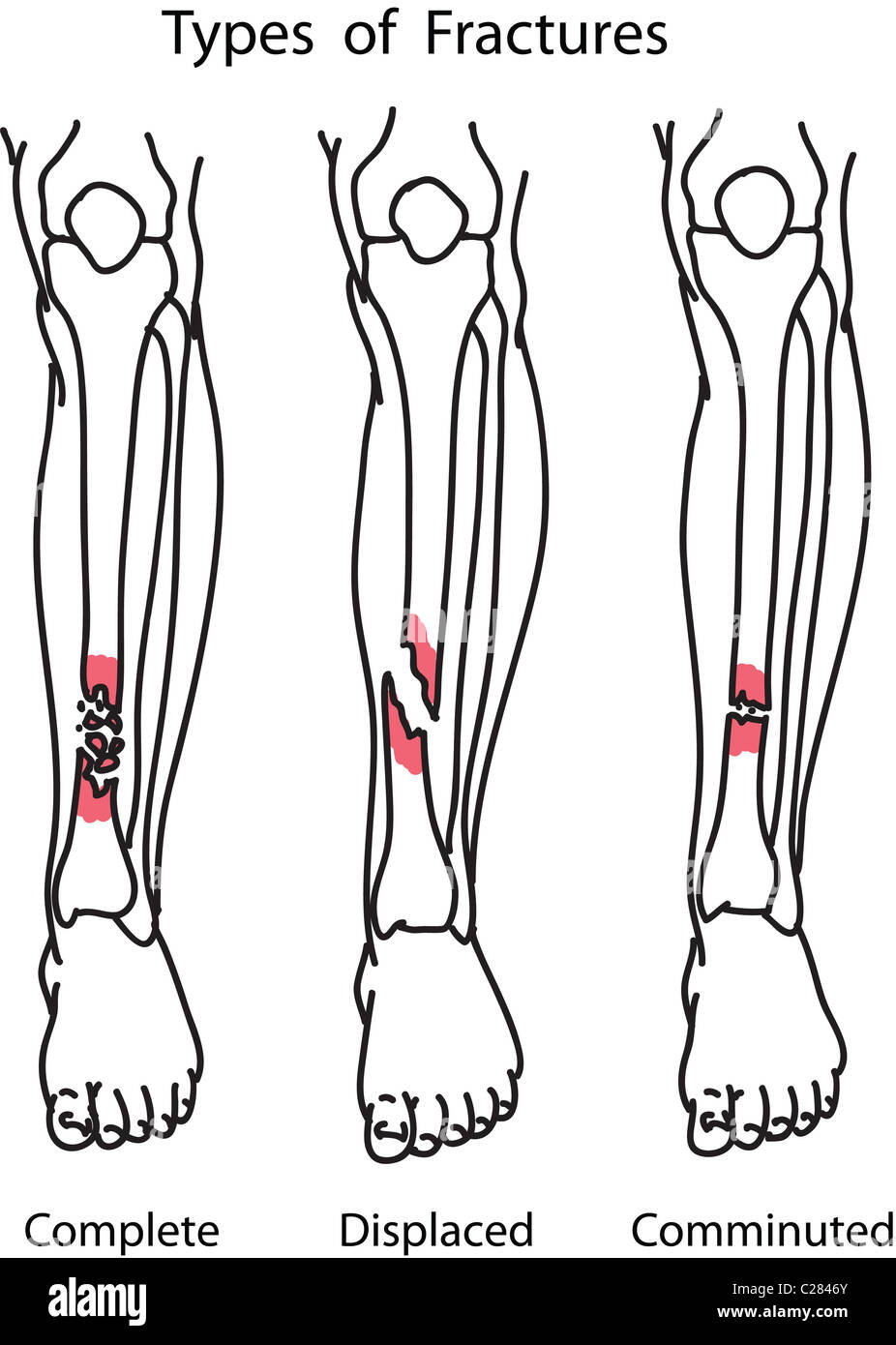 Types of human bone fractures illustration Stock Photo